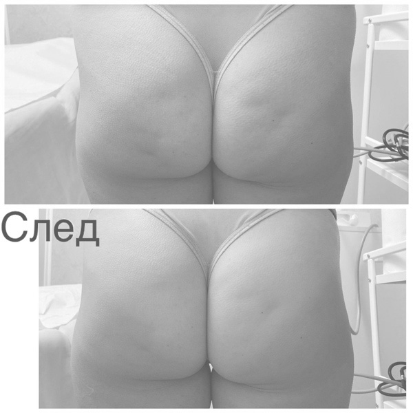 HIFU преди/след